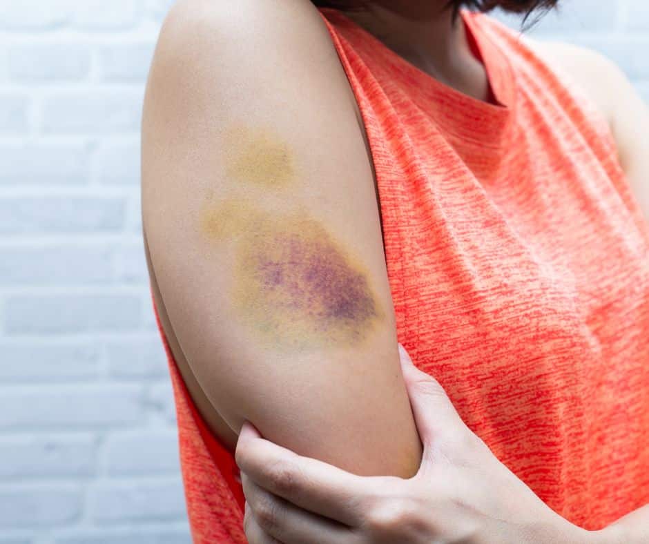 exercise-related bruising